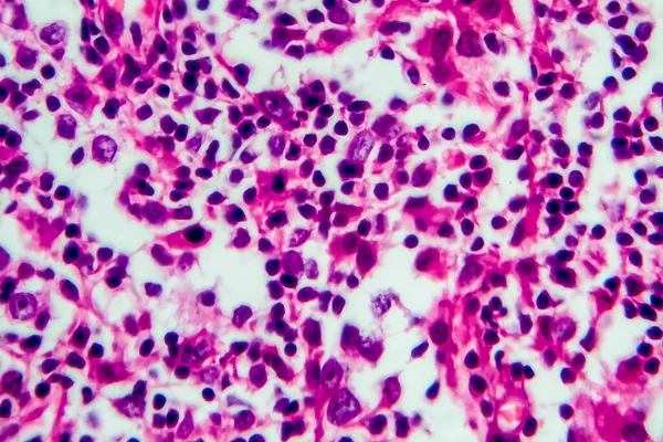 Hodgkin\'s lymphoma, light micrograph, photo under microscope