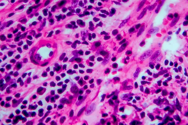 Hodgkin's lymphoma, light micrograph, photo under microscope. High magnification