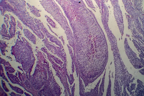 Carcinoma Células Transición Vesical Micrografía Ligera Foto Bajo Microscopio — Foto de Stock