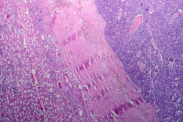 Опухоль Вильмса Нефробластома Световой Микрограф Фото Микроскопом — стоковое фото
