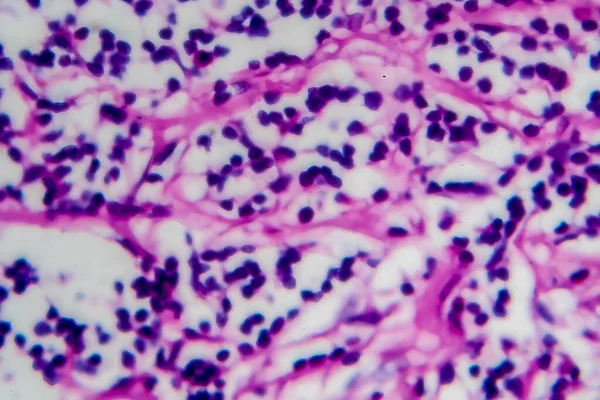 Hodgkin\'s lymphoma, light micrograph, photo under microscope. High magnification