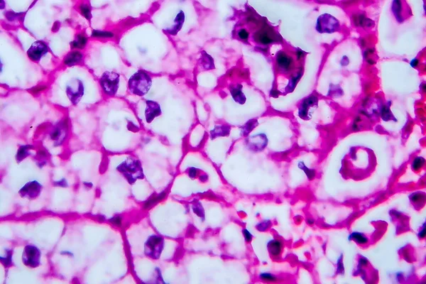 Renal cell carcinoma, light micrograph, photo under microscope. High magnification