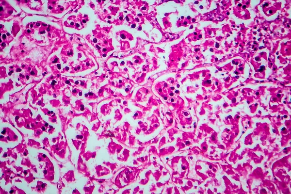 Karcinom Ledviny Světelný Mikrograf Fotografie Pod Mikroskopem — Stock fotografie