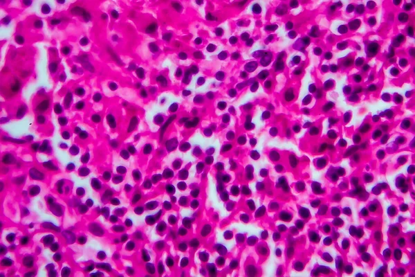 Non-Hodgkin\'s lymphoma, light micrograph, photo under microscope. High magnification