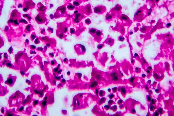 Carcinoma Células Renales Micrografía Ligera Foto Bajo Microscopio Alto Aumento — Foto de Stock