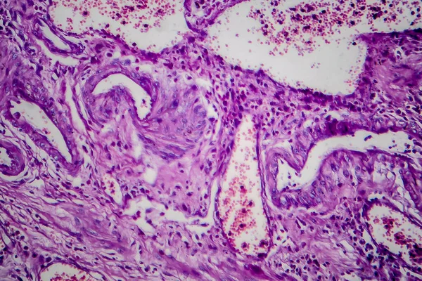 Bladder transitional cell carcinoma, light micrograph, photo under microscope