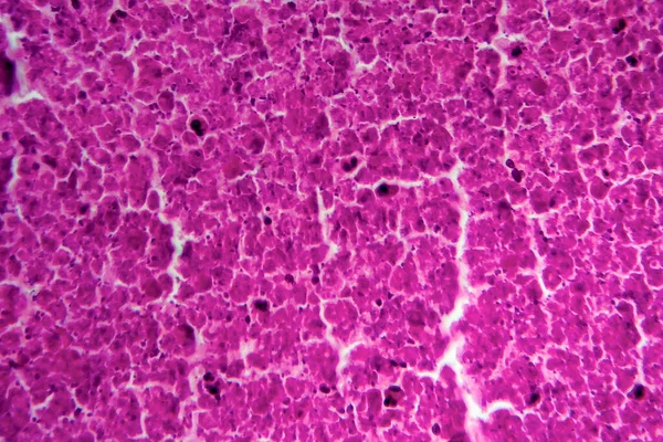 Почечный Туберкулез Световой Микрограф Фото Микроскопом — стоковое фото