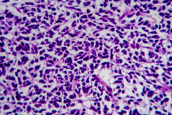 ウィルムス腫瘍 または腎芽腫 軽いマイクログラフ 顕微鏡下の写真 — ストック写真