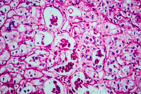 Carcinoma Células Renales Micrografía Ligera Foto Bajo Microscopio —  Fotos de Stock