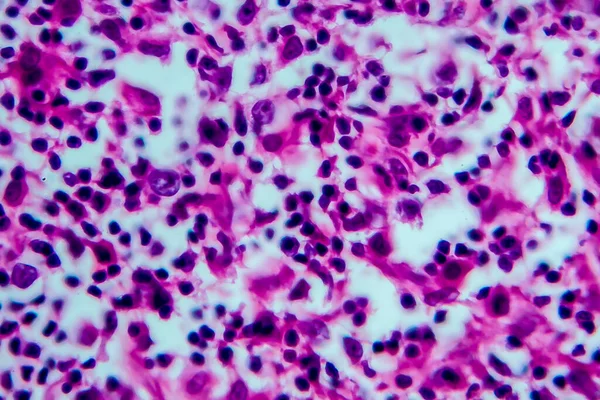 Hodgkin淋巴瘤光镜显微镜下照片高放大率 — 图库照片