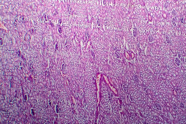 Пухлина Вілмса Або Нефробластома Легкий Мікрограф Фото Під Мікроскопом — стокове фото