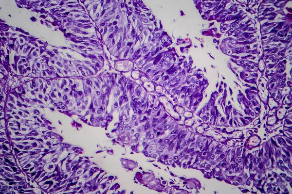 Carcinoma Células Transição Bexiga Micrografia Luz Foto Sob Microscópio — Fotografia de Stock
