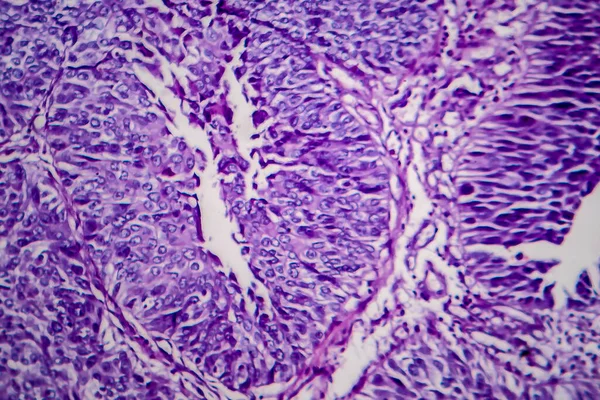 Húgyhólyag Átmeneti Sejt Carcinoma Fény Mikrográf Fénykép Mikroszkóp Alatt — Stock Fotó