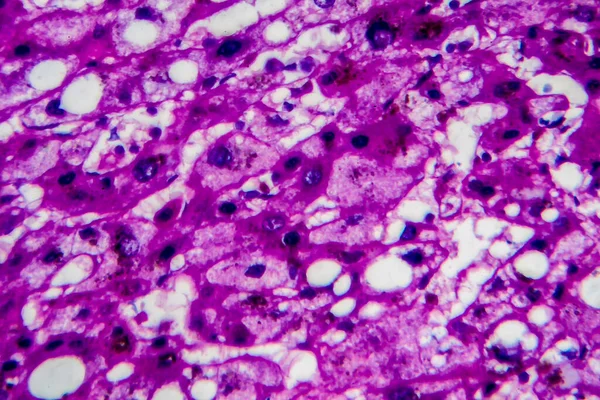 Histopatologia Hepatite Alcoólica Micrografia Luz Foto Sob Microscópio Elevada Ampliação — Fotografia de Stock