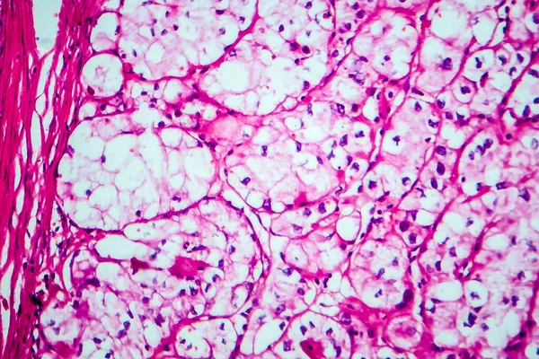 Vesesesejtes Carcinoma Fénymikrográf Fénykép Mikroszkóp Alatt — Stock Fotó