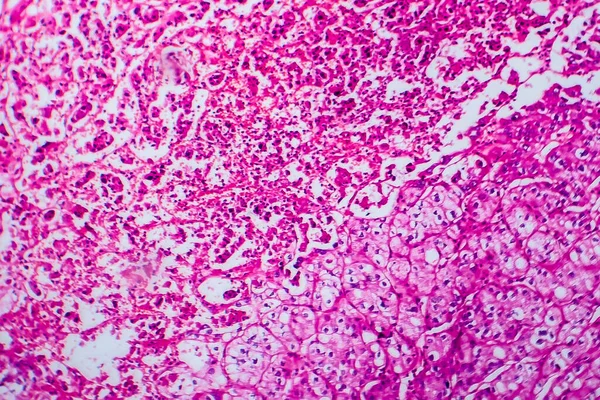 Vesesesejtes Carcinoma Fénymikrográf Fénykép Mikroszkóp Alatt — Stock Fotó