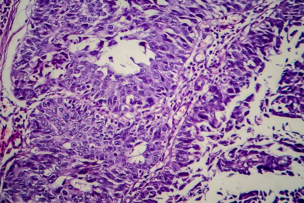 膀胱転移細胞癌 光マイクログラフ 顕微鏡下の写真 — ストック写真
