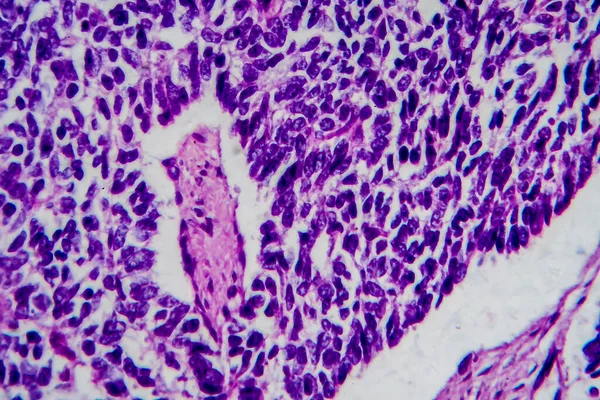 Wilms tumor, or nephroblastoma, light micrograph, photo under microscope. High magnification