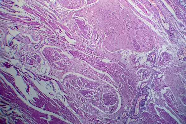 Carcinoma Cellule Transizionali Della Vescica Microscopio Leggero Foto Microscopio — Foto Stock