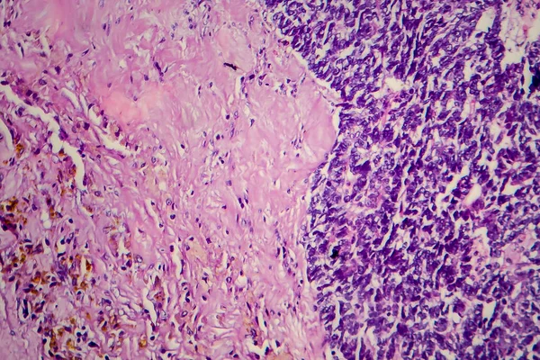 ウィルムス腫瘍 または腎芽腫 軽いマイクログラフ 顕微鏡下の写真 — ストック写真
