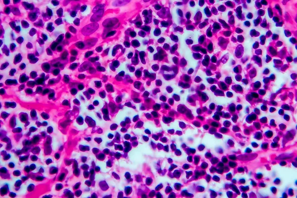 Hodgkin\'s lymphoma, light micrograph, photo under microscope. High magnification