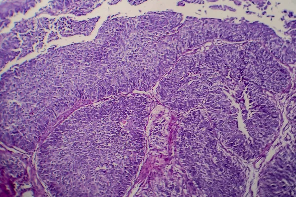 Přechodný Buněčný Karcinom Močového Měchýře Světelný Mikrograf Fotografie Pod Mikroskopem — Stock fotografie