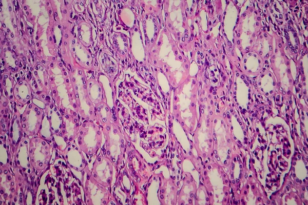 Wilms Tumor Nefroblastoma Micrografia Luz Foto Sob Microscópio — Fotografia de Stock