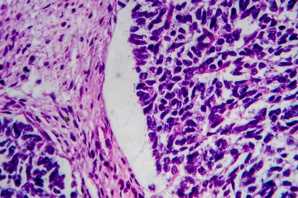 Wilms Tumor Oder Nephroblastom Lichtmikroskopie Foto Unter Dem Mikroskop — Stockfoto