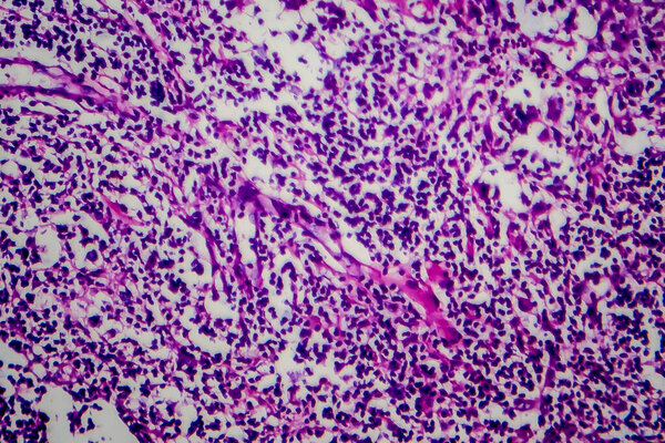 Hodgkin's lymphoma, light micrograph, photo under microscope