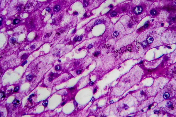 Histopathology of alcoholic hepatitis, light micrograph, photo under microscope. High magnification