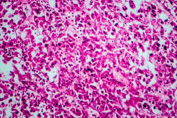 Rak Nerkowokomórkowy Mikrograf Światła Zdjęcie Pod Mikroskopem — Zdjęcie stockowe