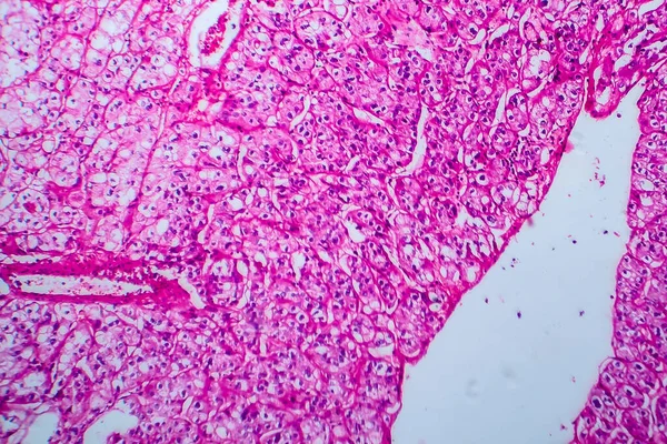 Carcinoma Células Renales Micrografía Ligera Foto Bajo Microscopio — Foto de Stock