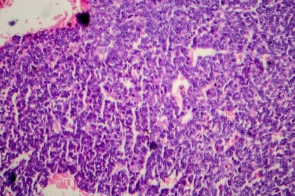 Tumor Wilms Atau Nefroblastoma Mikrograf Cahaya Foto Bawah Mikroskop — Stok Foto