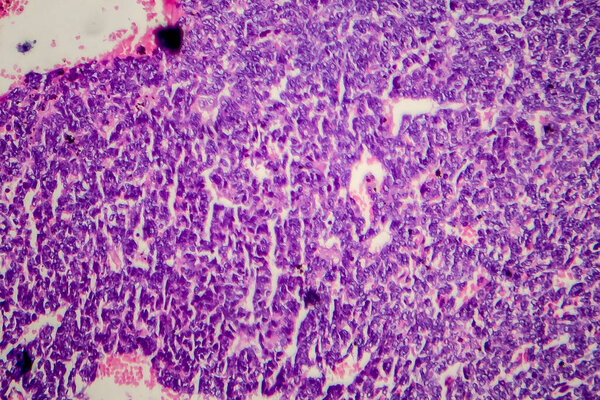 Wilms tumor, or nephroblastoma, light micrograph, photo under microscope
