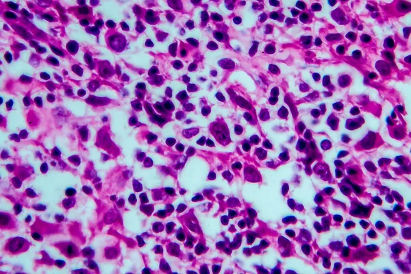 Hodgkin's lymphoma, light micrograph, photo under microscope. High magnification