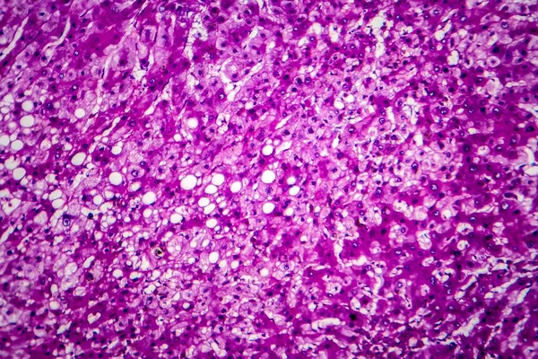 Histopatologie Alkoholické Hepatitidy Světelný Mikrograf Fotografie Pod Mikroskopem — Stock fotografie