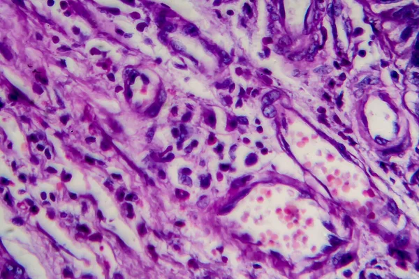 Bladder transitional cell carcinoma, light micrograph, photo under microscope. High magnification