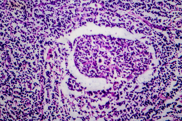 Hodgkin's lymphoma, light micrograph, photo under microscope