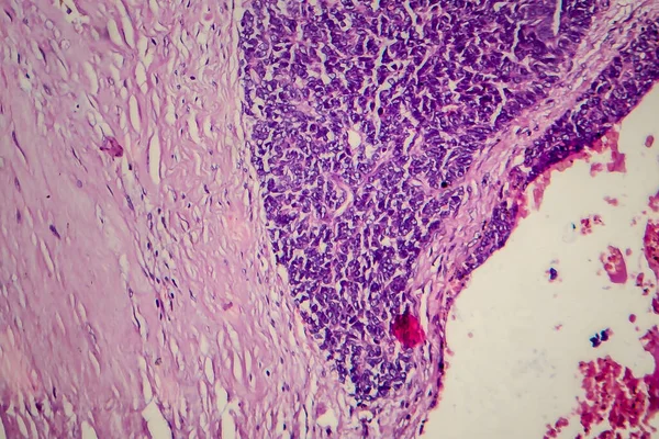 Tumor Wilms Atau Nefroblastoma Mikrograf Cahaya Foto Bawah Mikroskop — Stok Foto