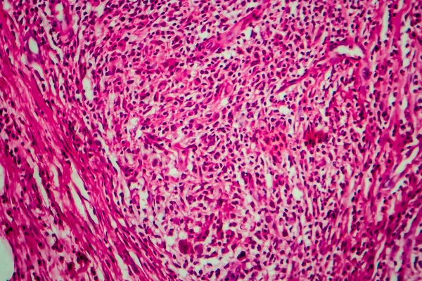 비호지킨 림프종 마이크로 그래프 현미경으로 — 스톡 사진