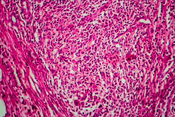 Non-Hodgkin's lymphoma, light micrograph, photo under microscope