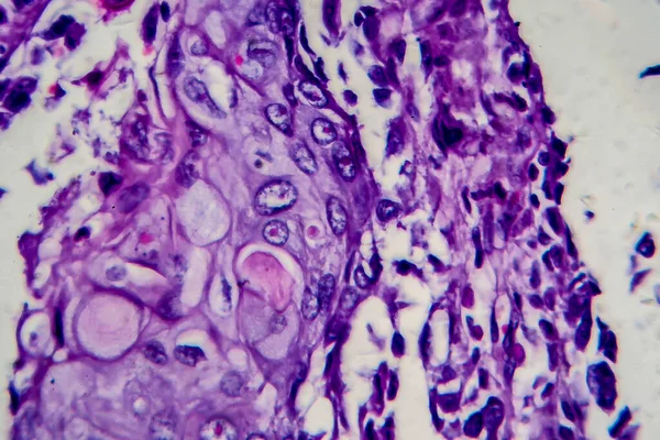 Bladder transitional cell carcinoma, light micrograph, photo under microscope. High magnification