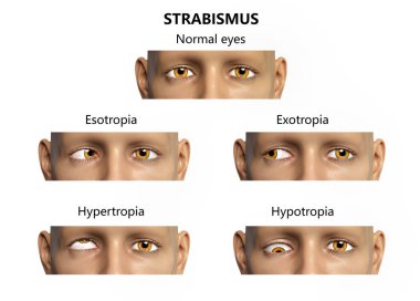 Strabismus, 3 boyutlu illüstrasyon farklı göz sapmaları gösteriyor