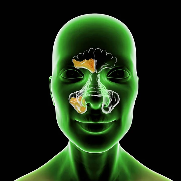 Sinusitis Inflammation Paranasal Cavities Illustration Showing Purulent Inflammation Frontal Maxillary — Stock Photo, Image