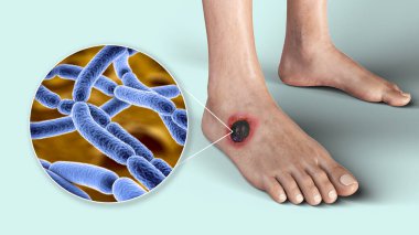 Cutaneous şarbon, şarbonun en yaygın formu. Deride ve bakteri bakterisi Bacillus anthracis 'in yakın çekim görünümünde karakteristik siyah eschar' ı gösteren 3D çizimler