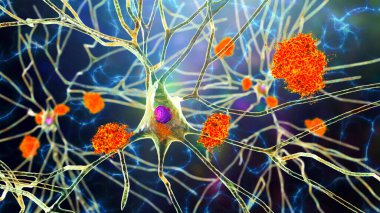 Neurons in Alzheimer's disease. 3D illustration showing amyloid plaques in brain tissue, neurofibrillary tangles and distruction of neuronal networks clipart