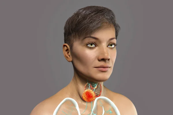 Thyroid cancer in women, 3D illustration showing tumor inside thyroid gland