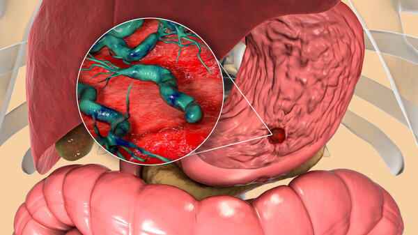 Stomach ulcer and closeup view of bacteria Helicobacter pylori, associated with ulcer formation, 3D illustration