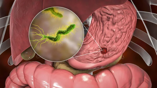 Ulkus Perut Dan Tampilan Closeup Bakteri Helicobacter Pylori Terkait Dengan — Stok Foto
