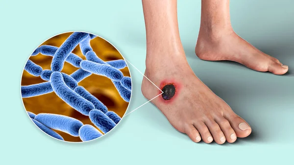 Cutaneous Şarbon Şarbonun Yaygın Formu Deride Bakteri Bakterisi Bacillus Anthracis — Stok fotoğraf